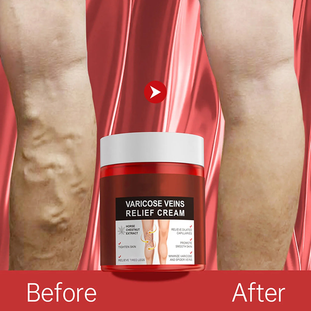 1/4 PCS Varicose Vein Relief Paste Improve Blood Circulations Spider Varicose Vein  For Tired Heavy Legs Fast Relief New